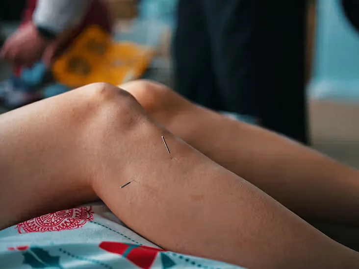 Needles for Restless Legs? What Emerging Research Suggests